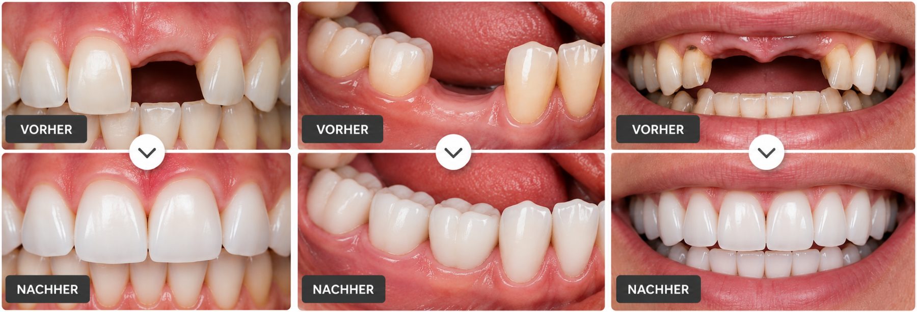 Vorher-Nachher-Beispiele von Zahnbehandlungen